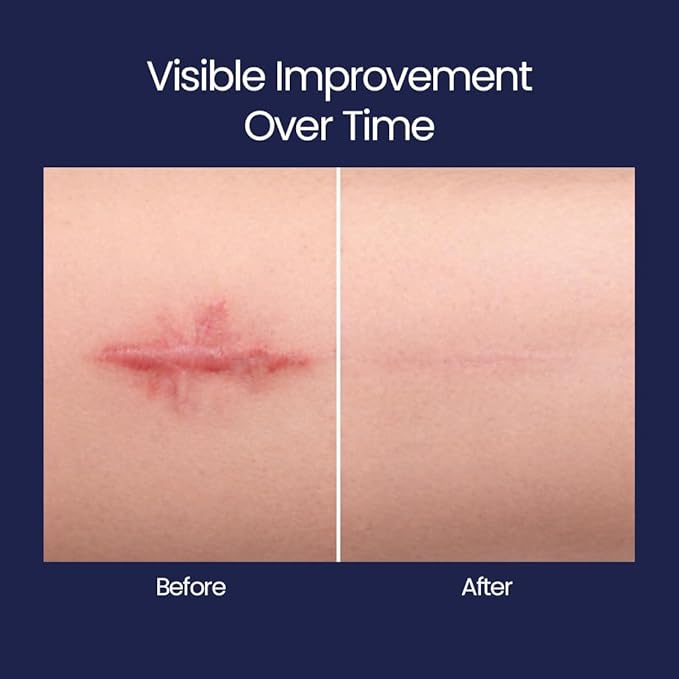 Silicone Scar Patches | Medical-Grade & Hypoallergenic Scar Care for Surgery, C Section Recovery, Keloids, Burns & Stretch Marks | 18 Pre-Cut Flexible Acne Scar Strips