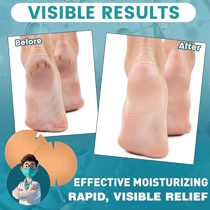 TEAWOO 30PCS Patented Cracked Heel Treatment Patches, Cracked Heel Repair Bandage (80mm x 80mm)