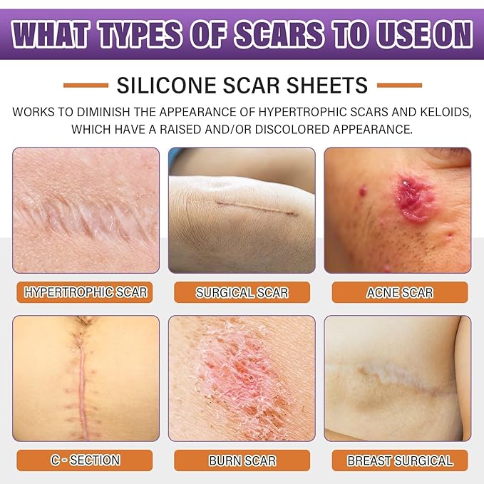 Silicone Scar Sheets, Medical Grade Silicone Scar Tape for Surgical, Hypertrophic, Keloid, C-Section, Burn, Old & New Scars, Reusable Professional Scars Removal Sheets (1.6"X 157" Roll-4M)