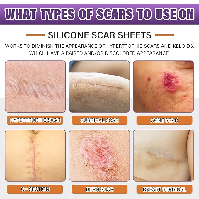 Silicone Scar Sheets, Medical Grade Silicone Scar Tape for Surgical, Hypertrophic, Keloid, C-Section, Burn, Old & New Scars, Reusable Professional Scars Removal Sheets (1.6"X 120" Roll-3M)