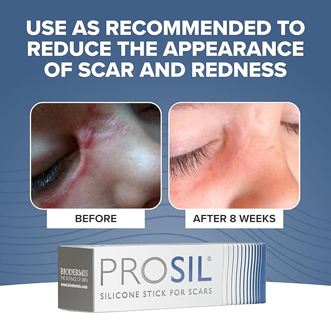 ProSIL Silicone Scar Stick - Scar Gel for Surgical Scars, Acne, & Burns - Silicone Gel for Scars is Safe for Children, Men & Women - Silicone Scar Gel Provides Effective Scar Therapy, 17g